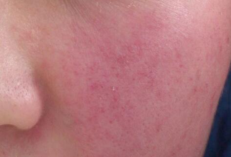 如何拯救你的敏感??？廣西南寧美容培訓(xùn)叫你正確方法