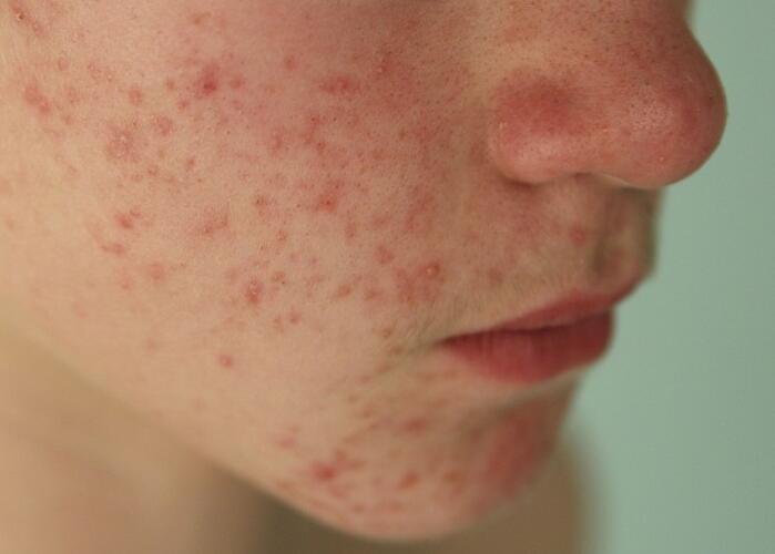 粉刺閉口應該如何處理？