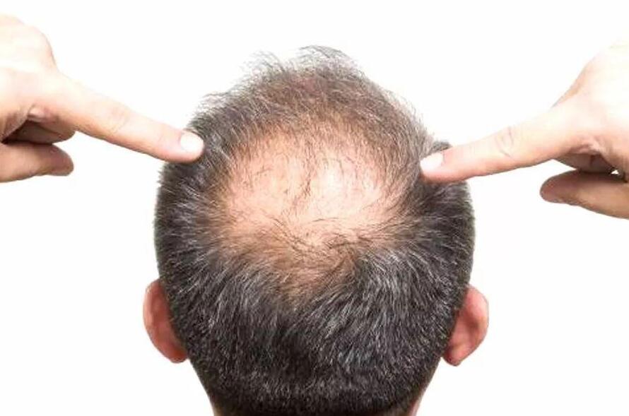 美發(fā)技巧：脫發(fā)可以用吹風(fēng)機(jī)嗎