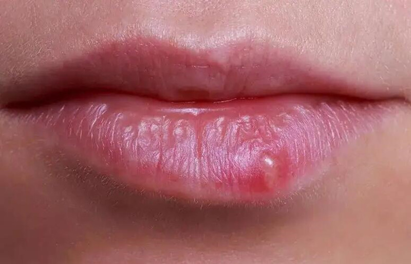 紋唇后起泡怎么辦？南寧紋唇培訓(xùn)學(xué)校教你方法