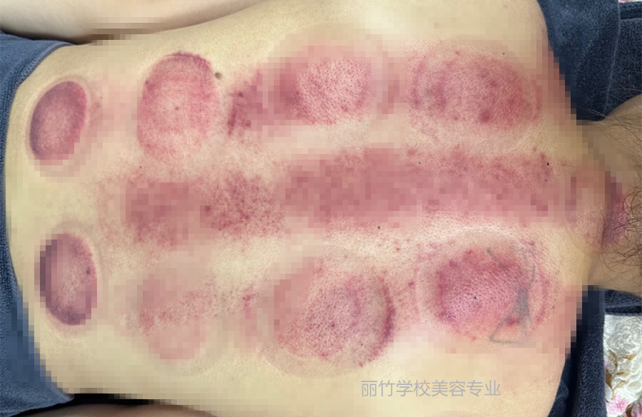 拔火罐的顏色代表什么？南寧美容美體專業(yè)實訓(xùn)