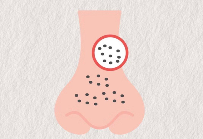 廣西皮膚管理師：面對嚴重的黑頭應(yīng)該怎么辦？